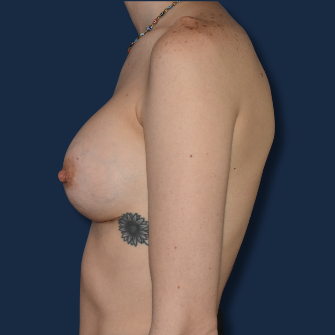 Breast Augmentation – After