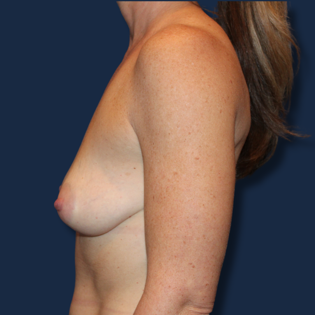 Breast Lift – Before